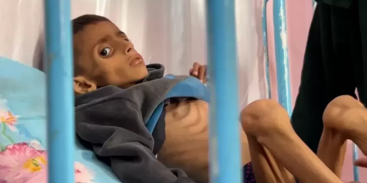 Mühasirə Qəzzada Mələkləri Yox Edir: Qidalanma Əskikliyindən 66 Uşaq Şəhid Oldu