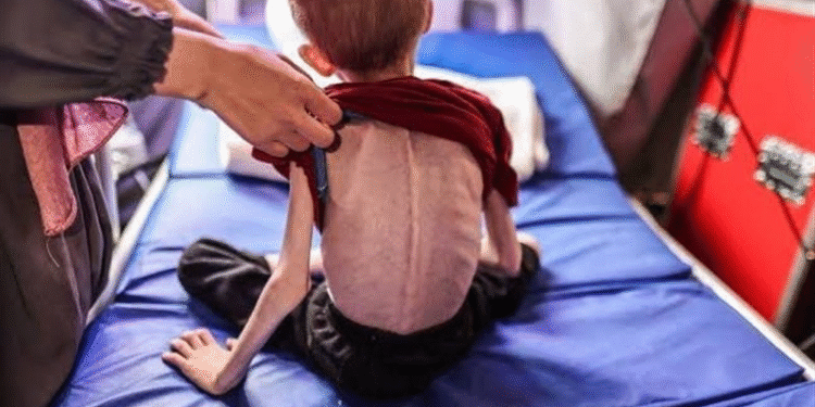 Qəzza müharibəsi – hər 10 uşaqdan 1-i qidalanma çatışmazlığından əziyyət çəkir